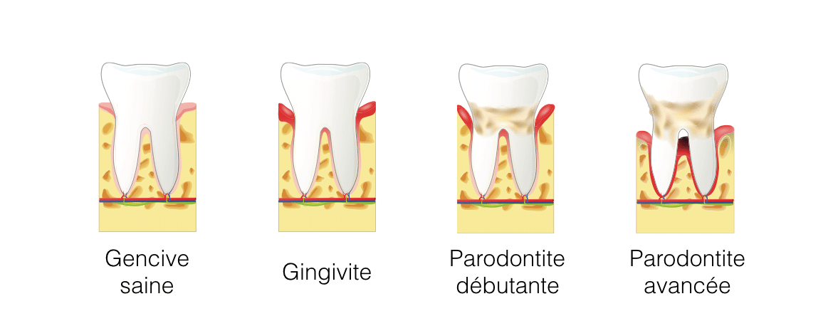 Visuel sur la parodontite